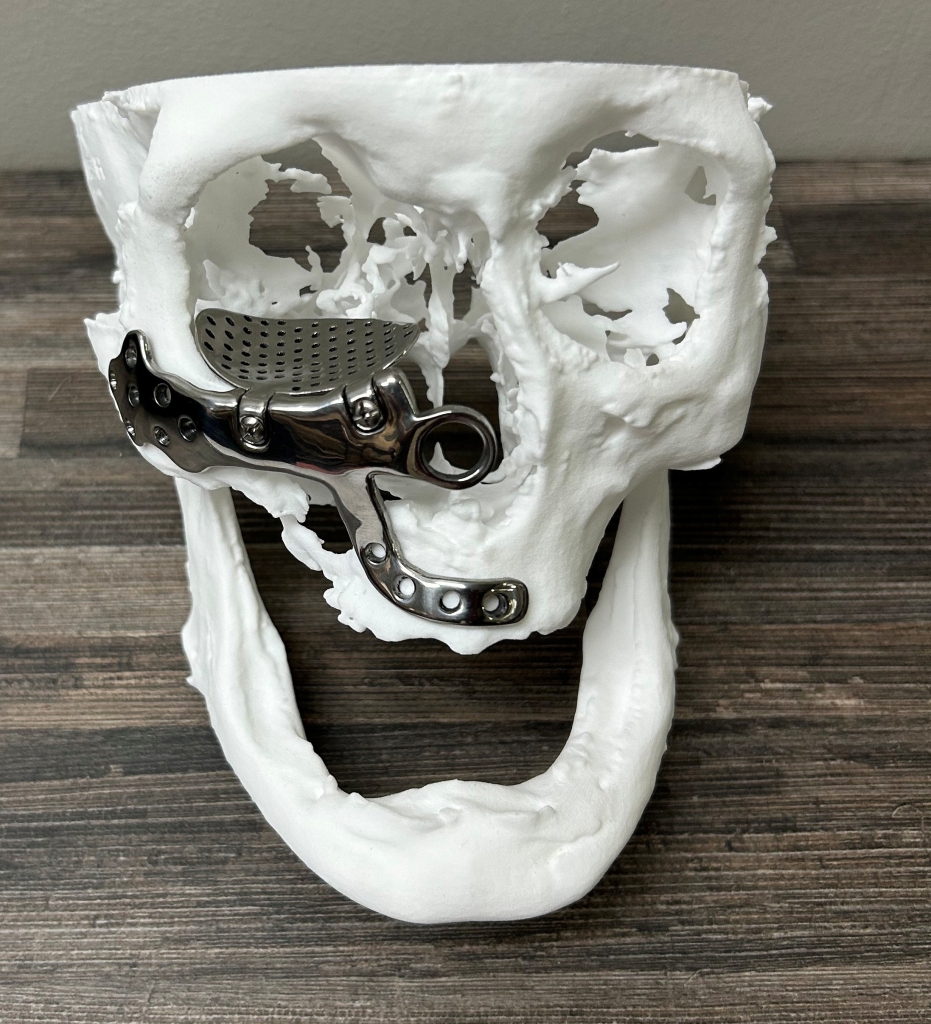 A custom maxillary frame implant.