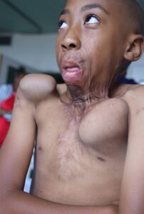 Jong brandslagoffer se uitkyk verbreed ná operasie danksy Smile-week