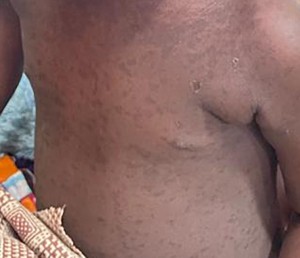 Measles outbreak in Khayelitsha: Health officials urge urgent child vaccinations