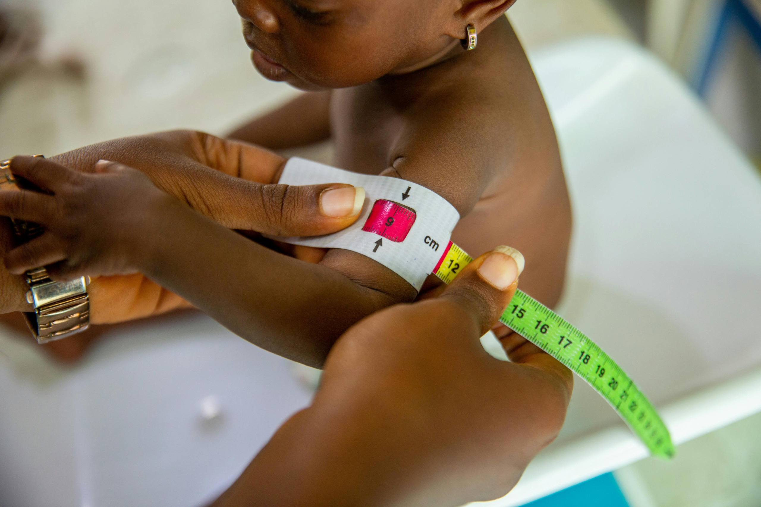 Volgens Unicef ly nagenoeg 290 000 Suid-Afrikaanse kinders aan ’n vorm van wanvoeding. Foto: Pexels