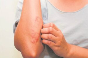 Could your inflammatory skin condition be atopic eczema?