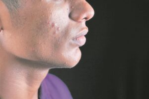 What to do about acne and pimples