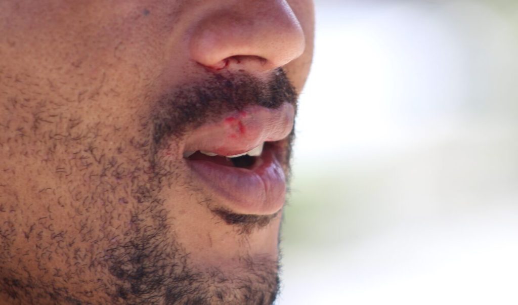 Alhoewel die persoon nie lewensgevaarlik gewond is nie, het hy wel ligte beserings aan sy mond opgedoen. Foto: Jamey Gordon