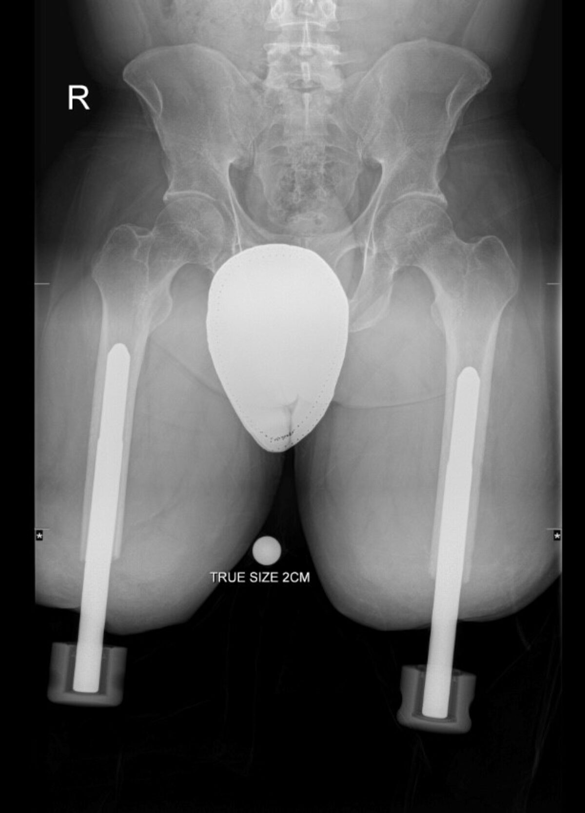 Pre-operative radiograph with bilateral above-knee socket prostheses.