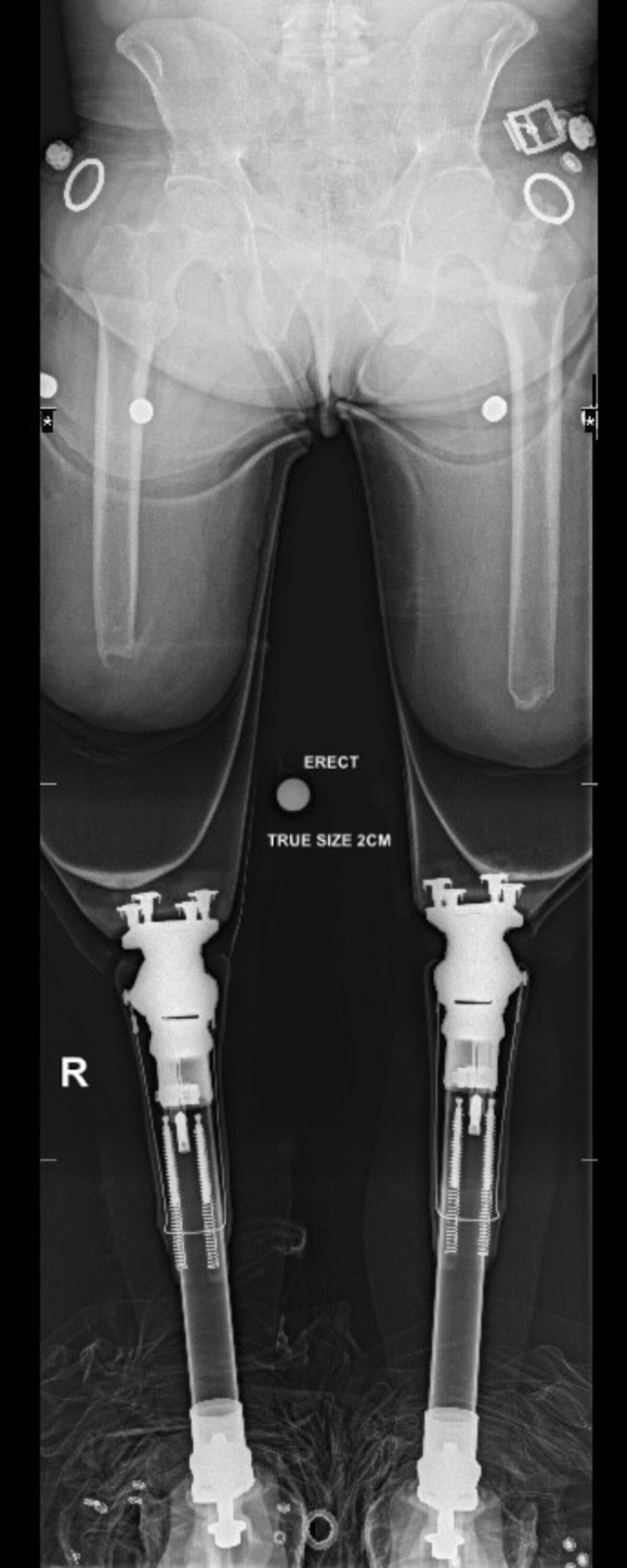 Post-operative radiograph showing osseointegrated prostheses in both femurs.