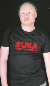 Living with albinism