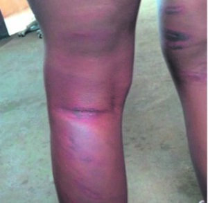 Teachers accused of assaulting a learner