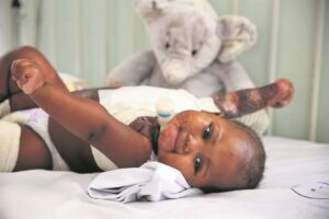 Burn treatment plans extended to meet growing needs