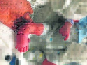 Surgery being done after 3 yrs of fundraising