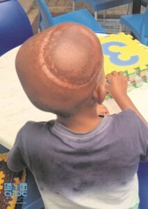 Childhood cancer: Valuable clues show up early