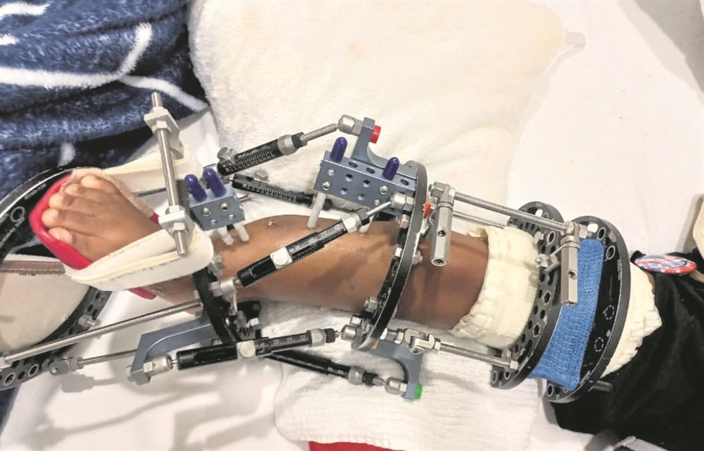 The fixator was fitted to Phetogo’s leg after the 