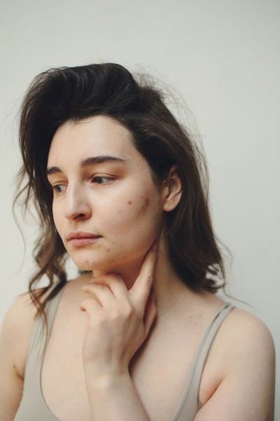 Aknee. Foto: Polina Tankilevitch, Pexels
