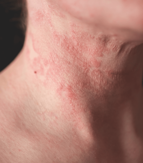 Ekseem. Foto: Hudson Dermatology and Laser Surgery