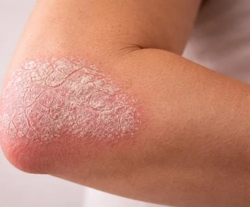 Plaak psoriase. Foto: Nopsor USA