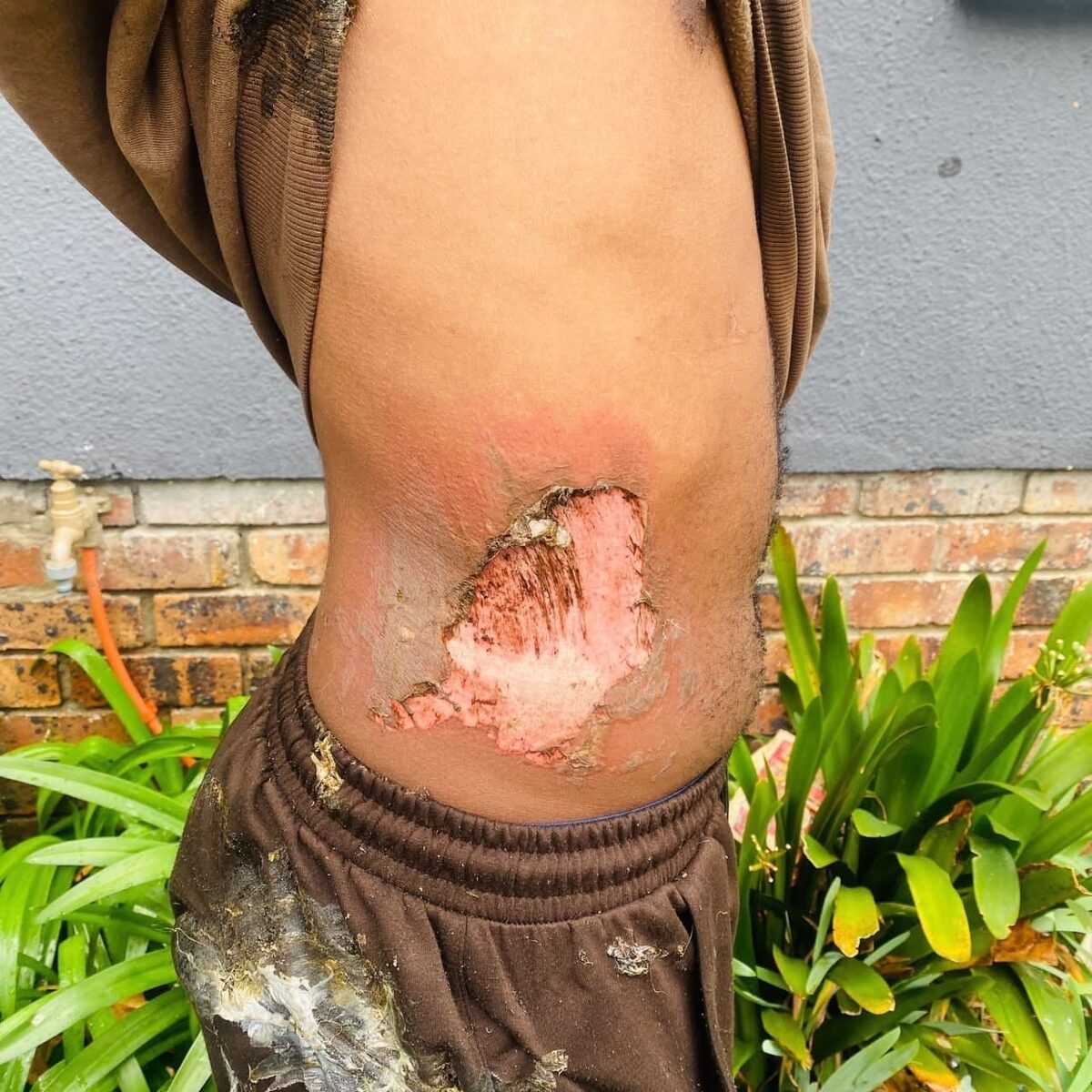Student hospitalised after room set alight at Stellenbosch