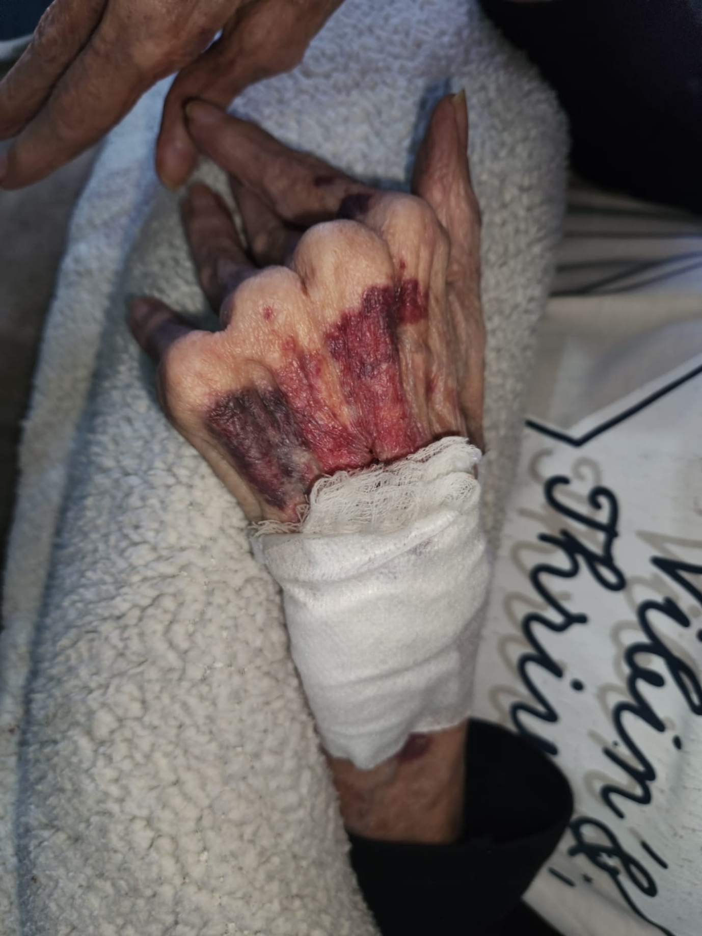 A photograph of the hand of the 81-year-old after the duct tape was removed