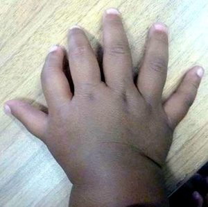 Gebore met ekstra vinger of toon: Wat is ‘polidaktilie’?
