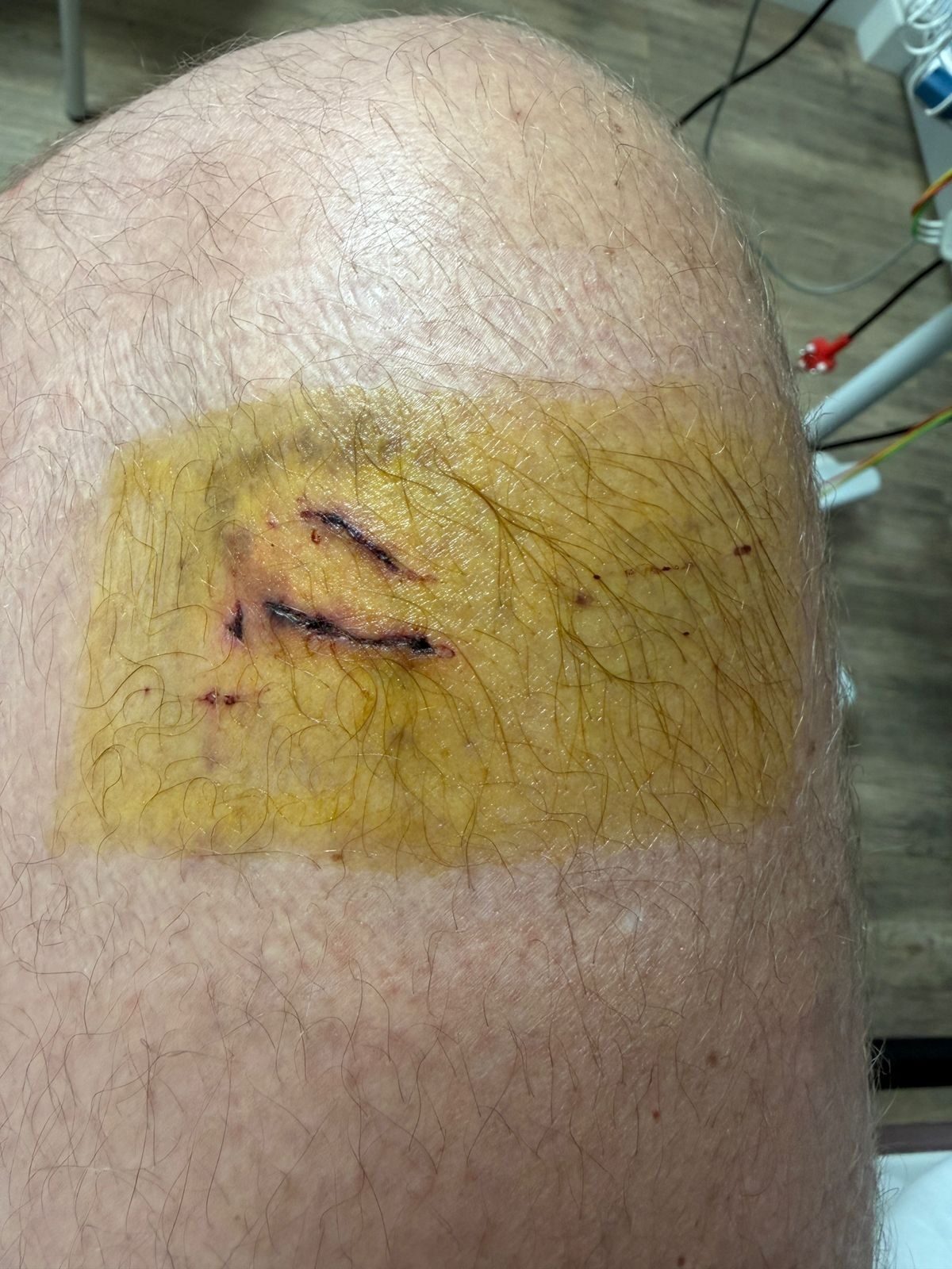 Die wond aan Zack Rossouw se been drie dae ná die aanval.
