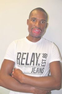 Burn victim struggles to pick his life up after job loss
