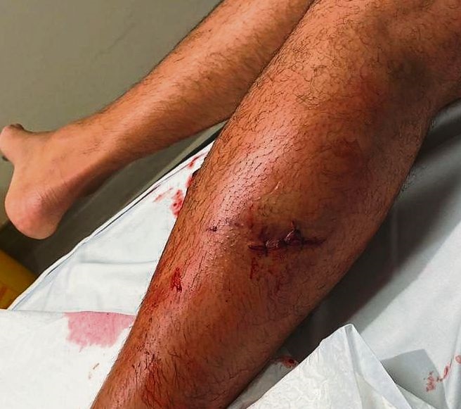 Een van die bytmerke aan sy kuit is met steke gehe