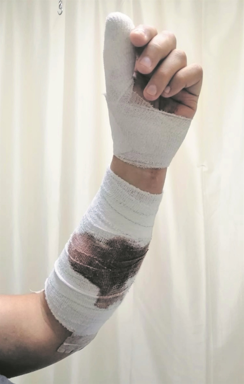 Man attacked by pitbull says he could feel his bones crunching