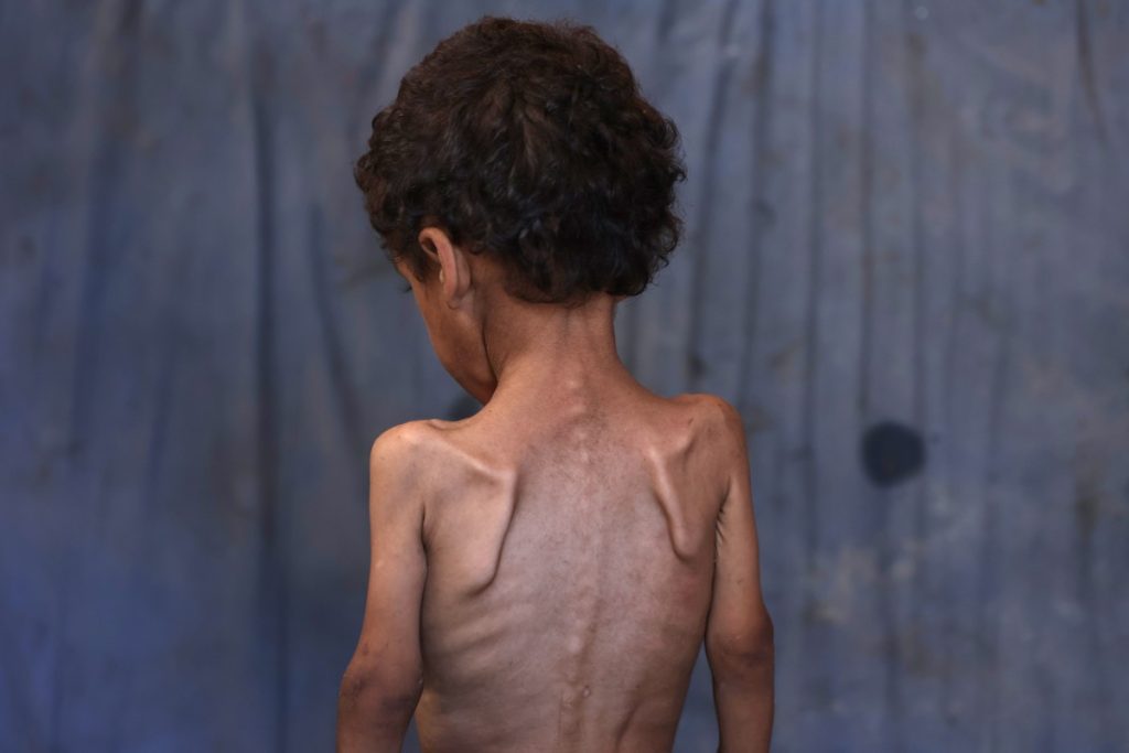 Yazan, a malnourished 2-year-old Palestinian boy, stands with his back turned in his family's damaged home in the Al-Shati refugee camp, west of Gaza City, on 23 July. 