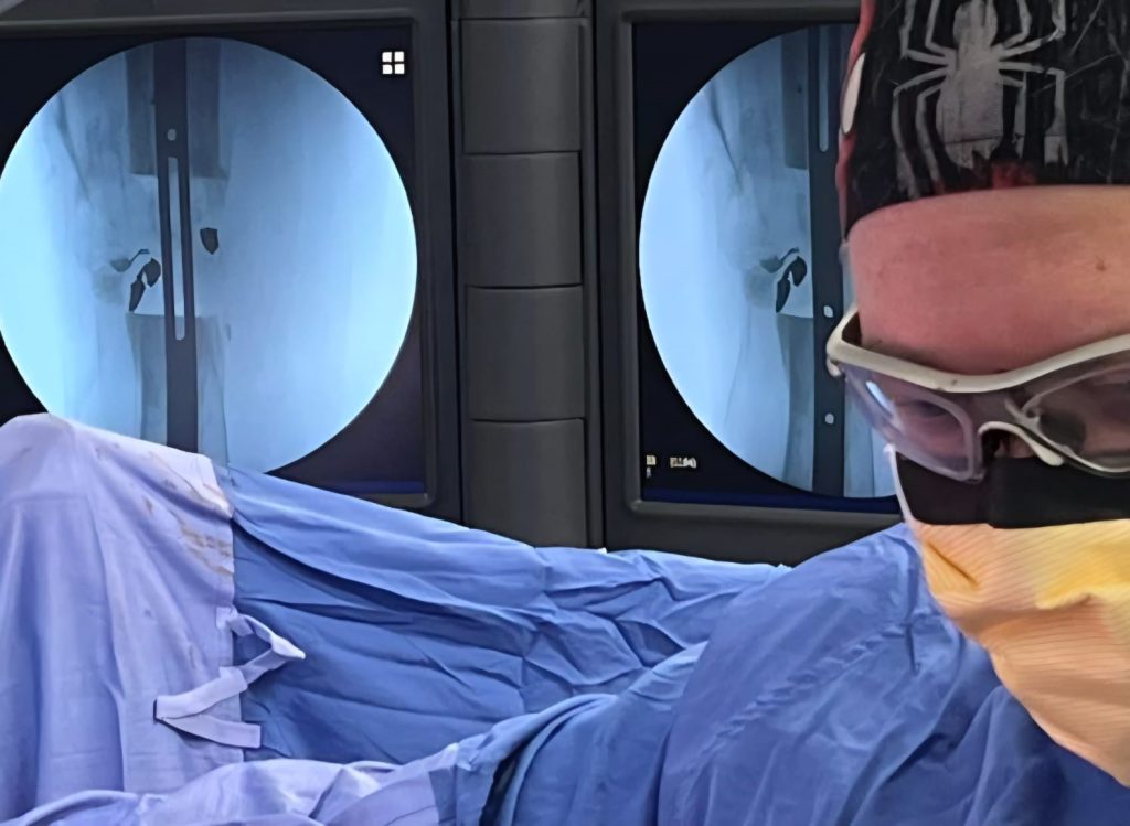 Intraoperative fluoroscopy image showing the definitive nail being inserted and bridging the bone defect. 