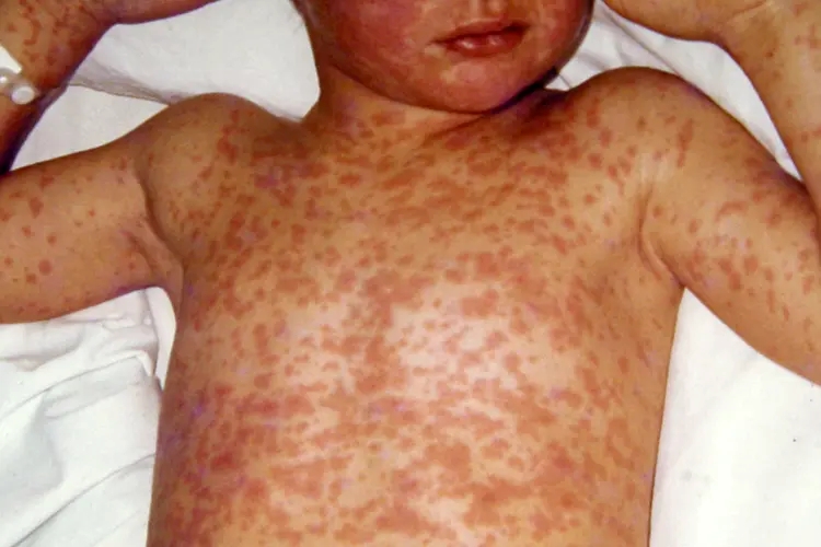 Measles outbreak hits Western Cape as vaccination rates decline