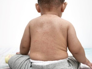 More than 500 children die in Bangladesh measles outbreak
