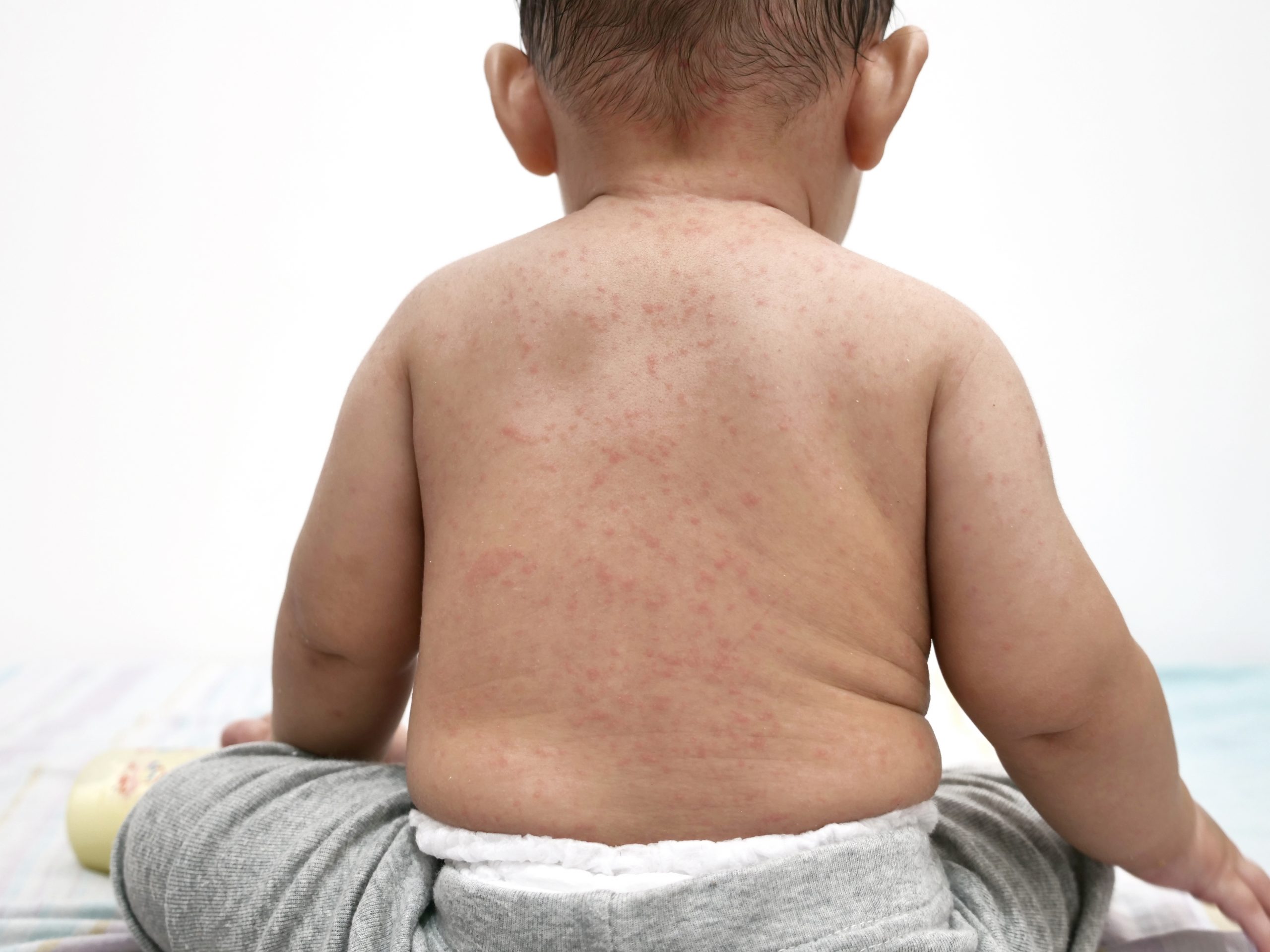 measles outbreak