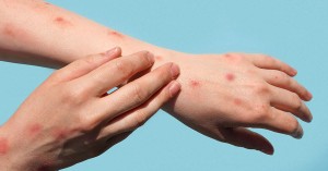 Health department urges vigilance as mpox cases surge in South Africa