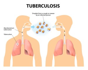 Western Cape targets TB testing to curb silent transmission
