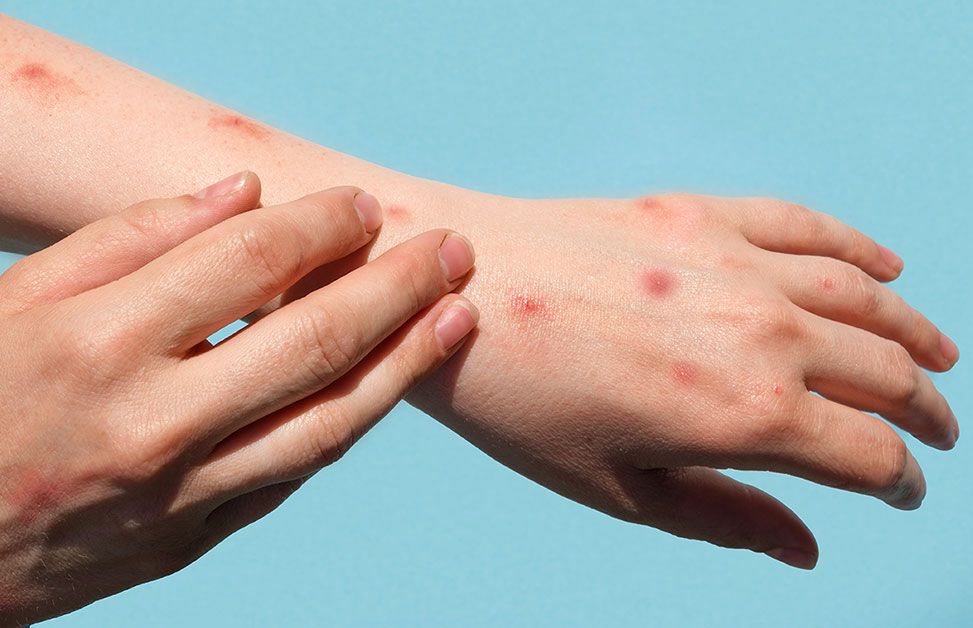 A person with mpox.